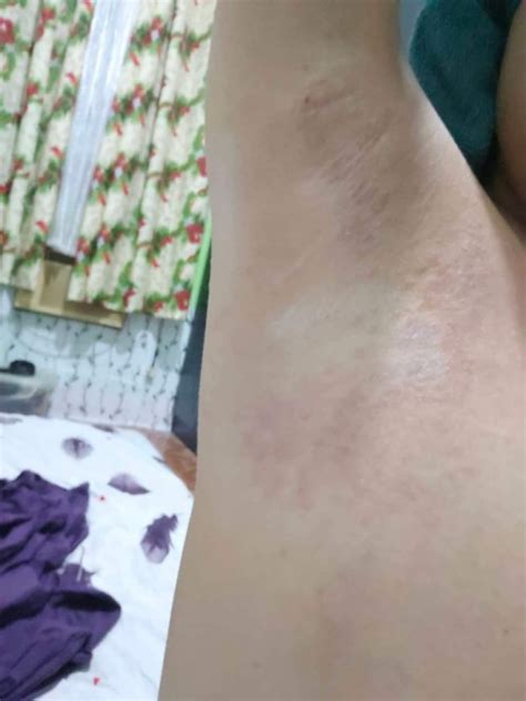underarm rashes sa kilikili|Underarm Rashes Sa Kilikili .